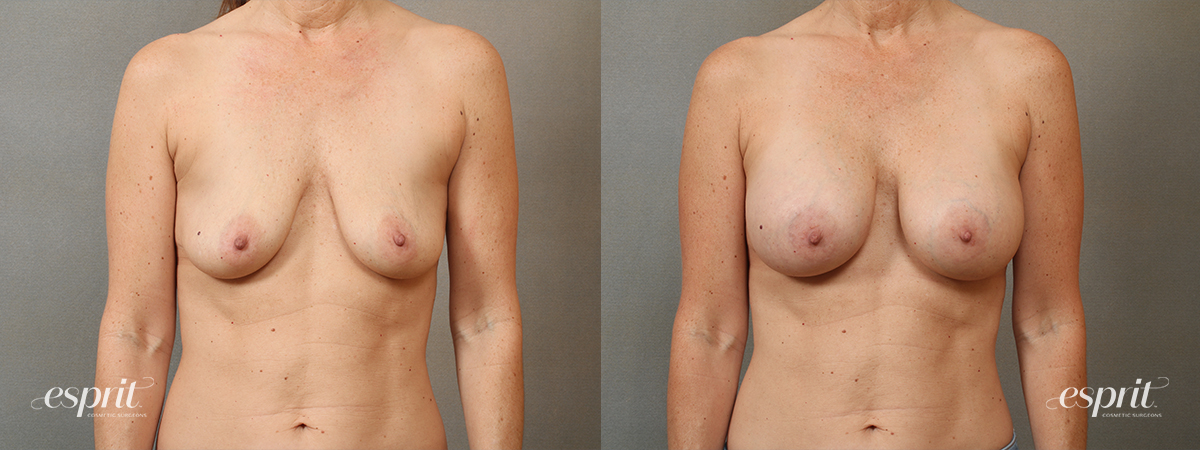Case 4105 Breast Augmentation Before and After Front View