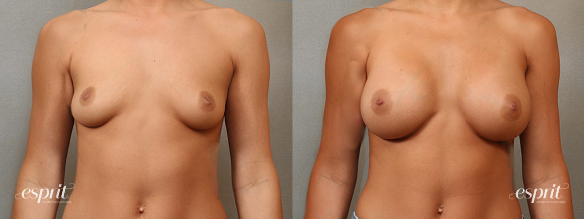 Case 4106 Breast Augmentation Before and After Front View