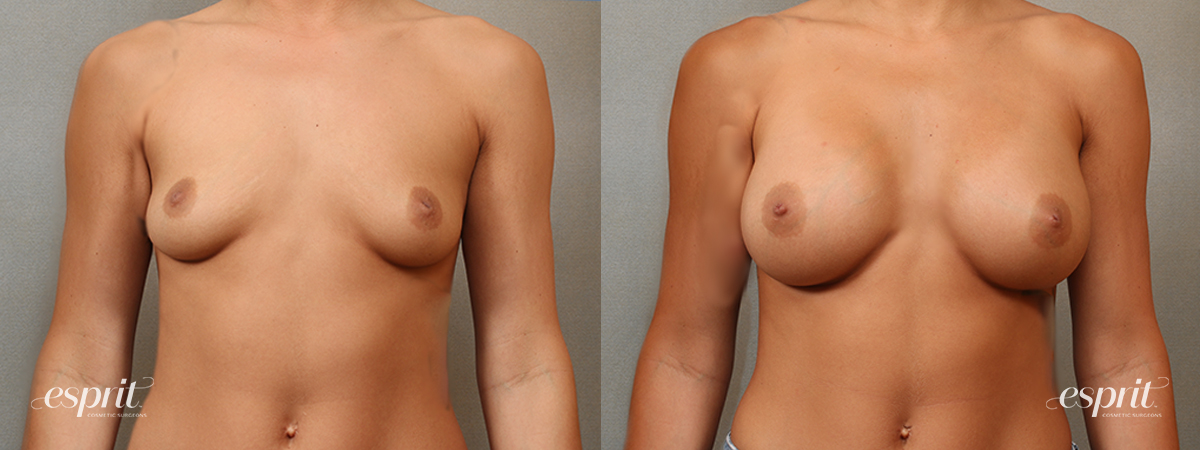 Case 4106 Breast Augmentation Before and After Front View