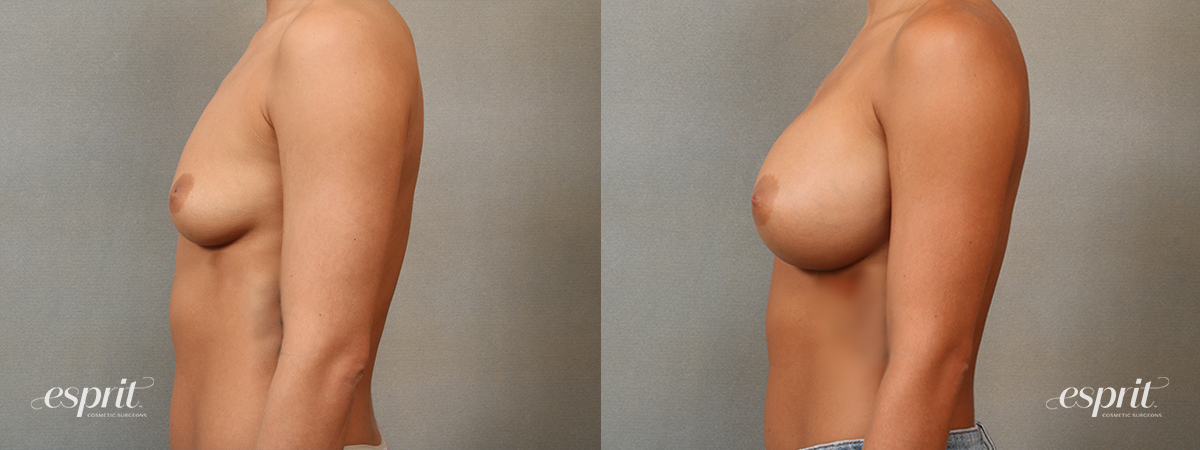 Case 4106 Breast Augmentation Before and After Left Side View