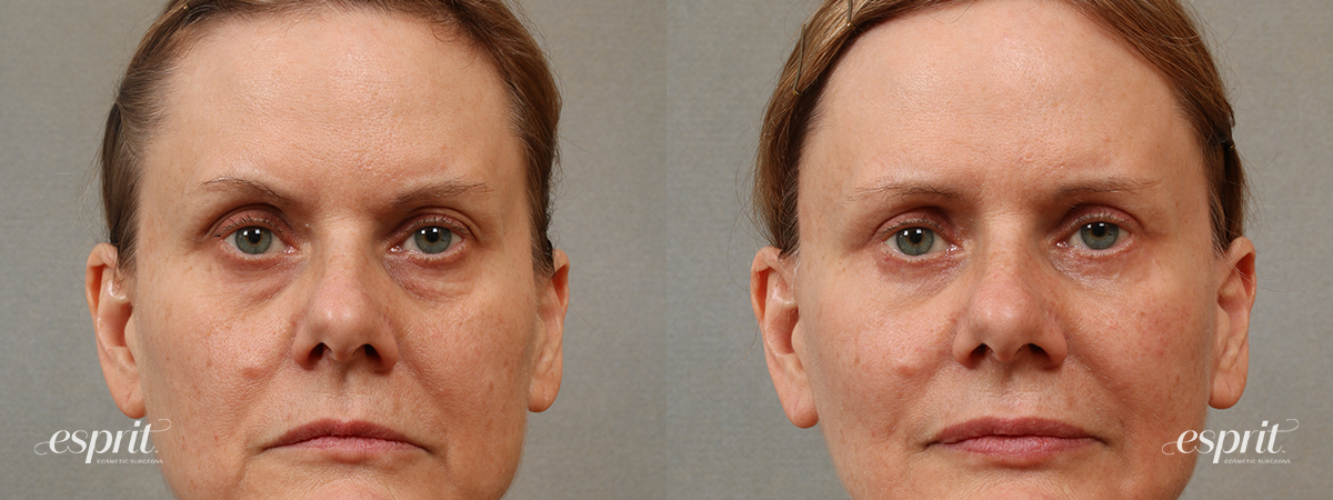 Case 3105 blepharoplasty before and after front view esprit® cosmetic surgeons