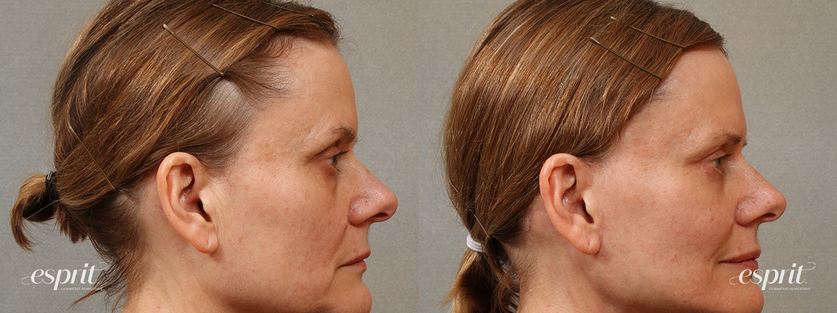 Case 3105 blepharoplasty before and after right side view esprit® cosmetic surgeons