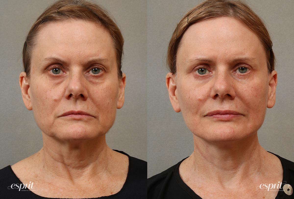 Case 3105 Face & Neck Lift Before and After Front View