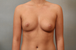 Breast fat grafting case study photo 3 esprit® cosmetic surgeons