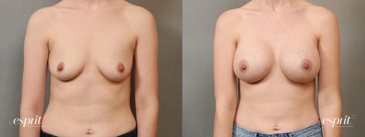 Case 4107 Breast Augmentation Before and After Front View