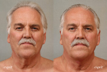 Case 3106 platysmaplasty before and after front view esprit® cosmetic surgeons