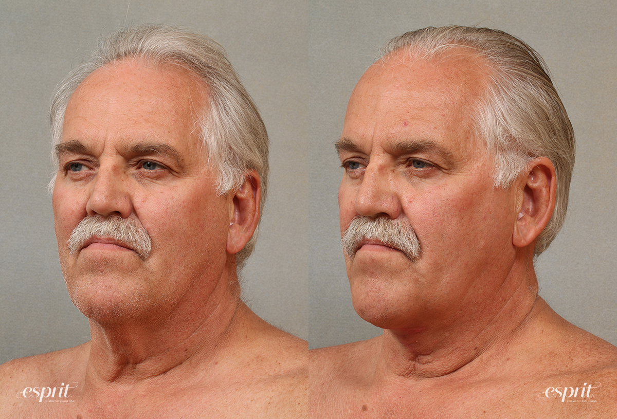 Case 3106 Platysmaplasty Before and After Left Oblique View