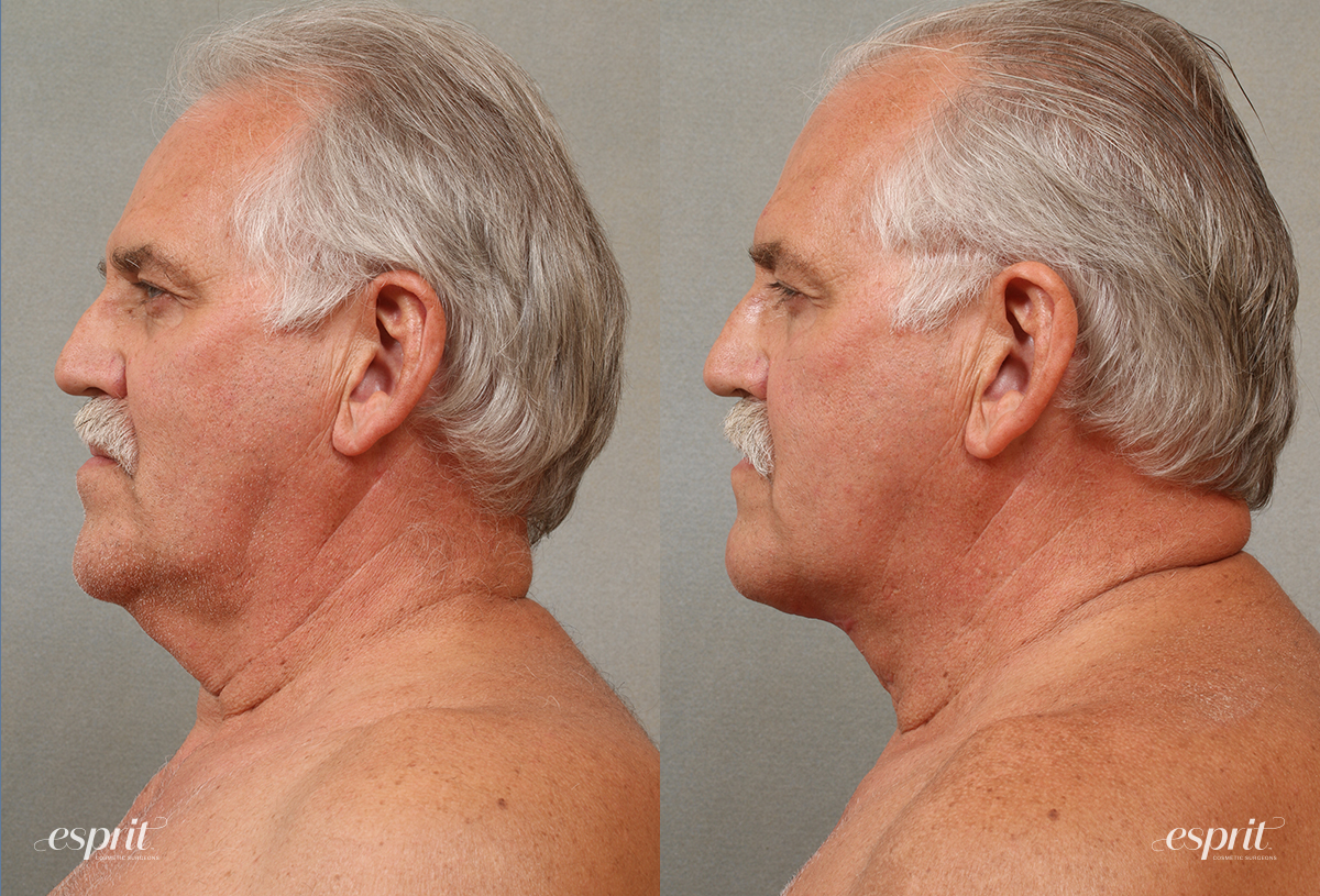 Case 3106 Platysmaplasty Before and After Left Side View