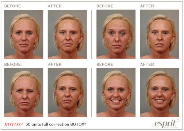 botox party case study