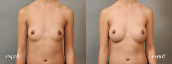 Case 4108 Breast Augmentation Before and After Front View