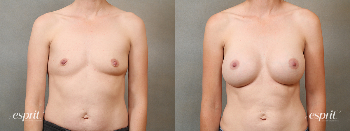 Case 4109 Breast Augmentation Before and After Front View