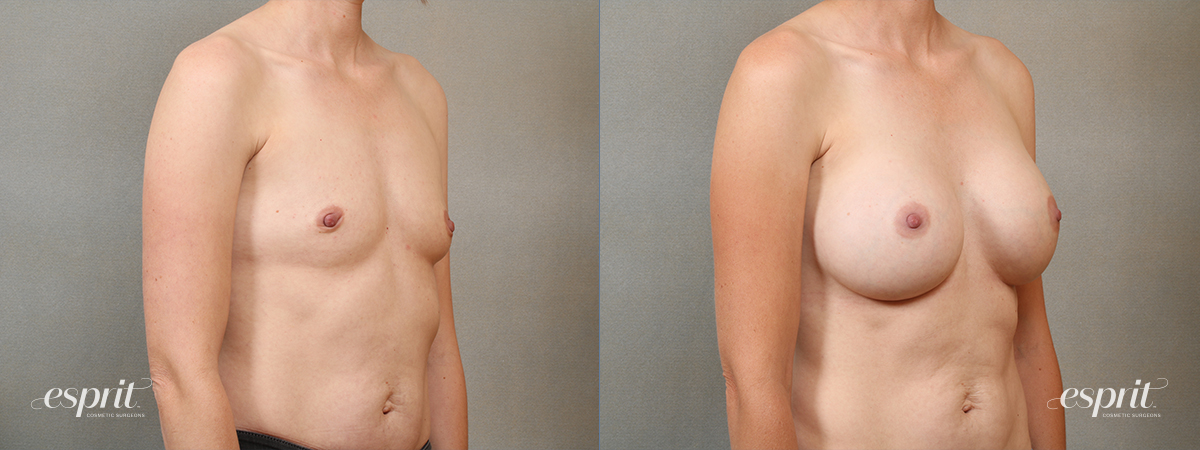 Case 4109 Breast Augmentation Before and After Right Oblique View
