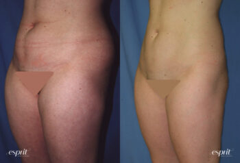 Case 1192 Liposuction Before and After Front Oblique View