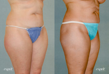 Case 1195 Liposuction Before and After Front Oblique View