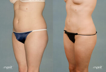 Case 1220 Liposuction Before and After Front Oblique View