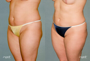 Case 1222 Liposuction Before and After Front Oblique View