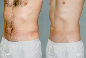 Case 1223 Liposuction Before and After Front Oblique View