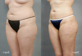 Case 1233 Liposuction Before and After Front Oblique View