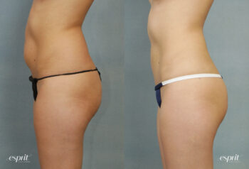 Case 1283 Liposuction Before and After Left Side View