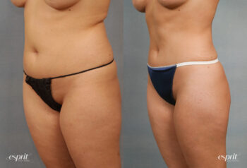 Case 1347 Liposuction Before and After Left Oblique View