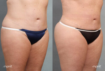 Case 1485 Liposuction Before and After Right Oblique View