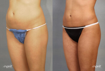 Case 1544 Liposuction Before and After Left Oblique View