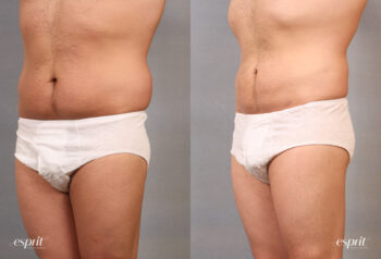 Case 1663 Liposuction Before and After Left Oblique View