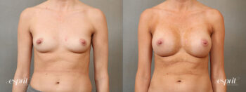 Case 4110 Breast Augmentation Before and After Front View