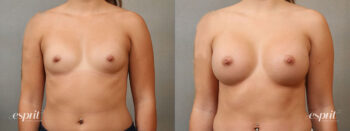 Case 4111 Breast Augmentation Before and After Front View