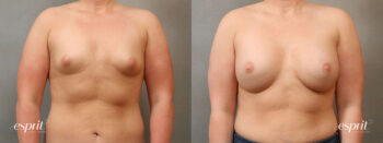 Case 4112 Breast Augmentation Before and After Front View