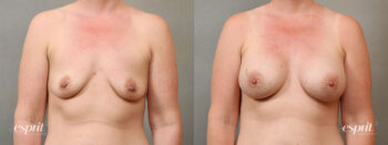Case 4113 Breast Augmentation Before and After Front View