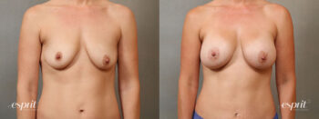 Esprit_Tualatin_Breast_Augmentation_Case4115_Front