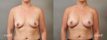 Esprit_Tualatin_Breast_Augmentation_Case4117_Front