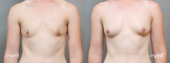 Breast Augmentation 2205, Front