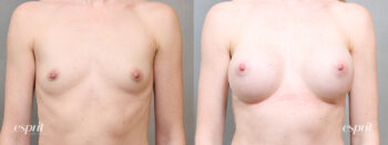 Breast Augmentation 5109, Front