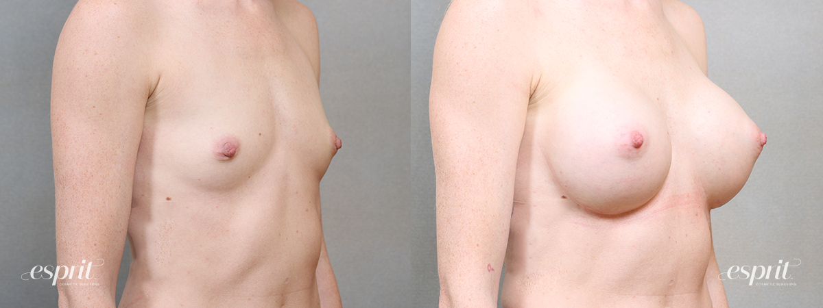Breast fat grafting 2205 oblique 1 esprit® cosmetic surgeons