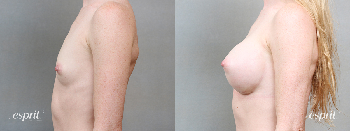 Breast augmentation 5109 side 1 esprit® cosmetic surgeons