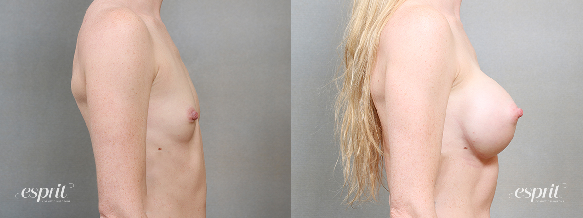 Breast augmentation 5109 side 1 esprit® cosmetic surgeons