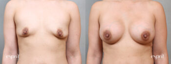 Breast Augmentation 5111, Front