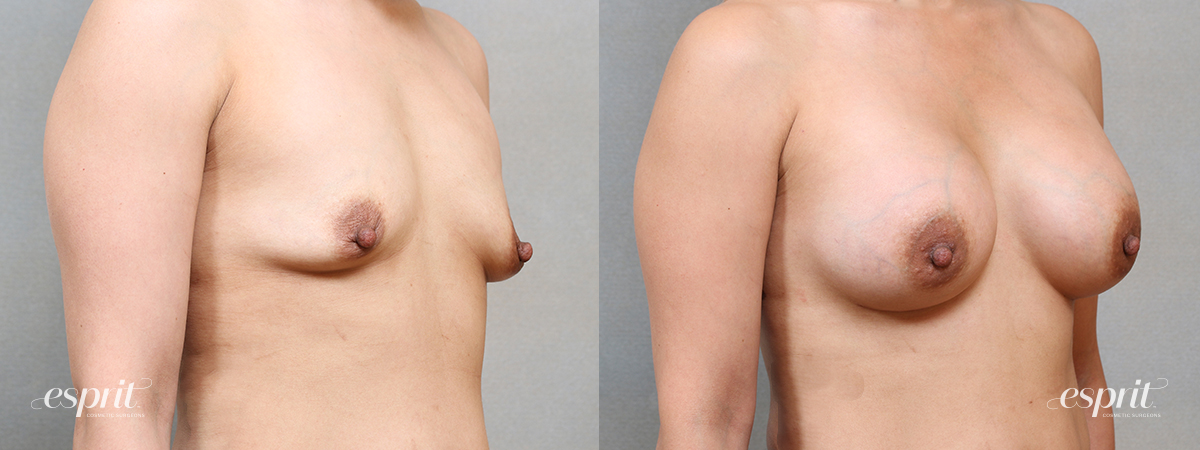 Breast Augmentation 5111, Oblique 2