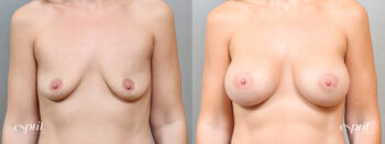 Breast Augmentation 5114, Front