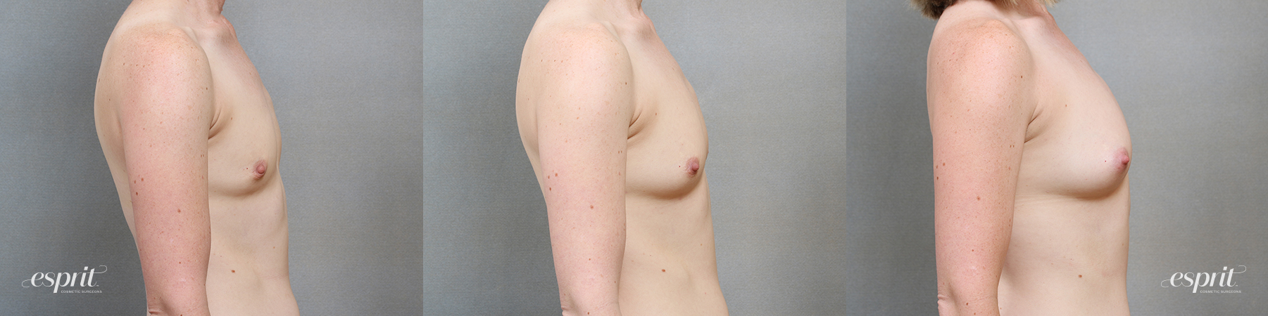 Breast Fat Grafting 2205, Side 2
