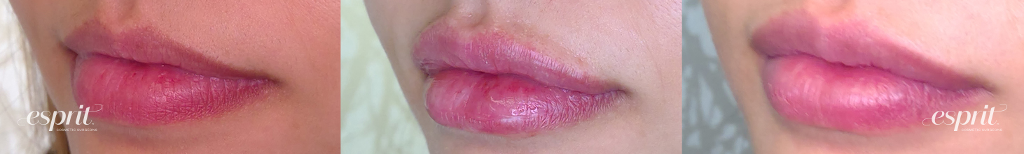 Lips 1233, Oblique