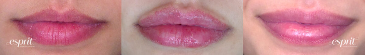 Lips 1233 Front