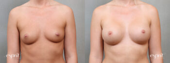 Breast Augmentation 5115, Front