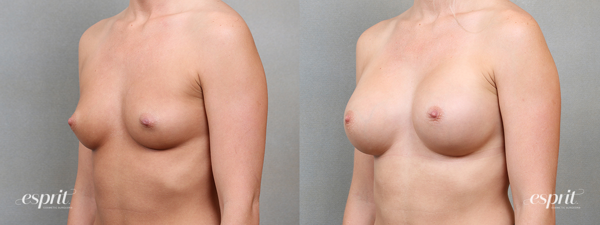 Breast Augmentation 5115, Oblique