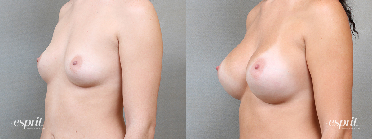 Breast Augmentation 5116, Oblique 1