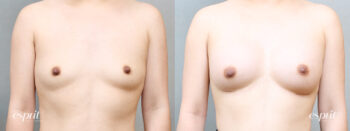 Breast Augmentation 1716, Front