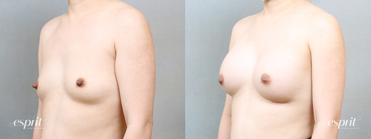 Breast Augmentation 1716, Oblique 1