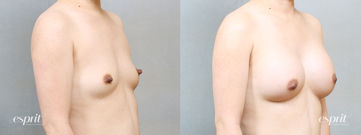 Breast Augmentation 1716, Oblique 2